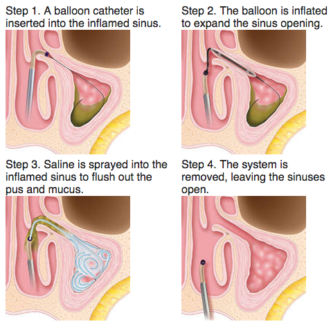 Balloon catheter